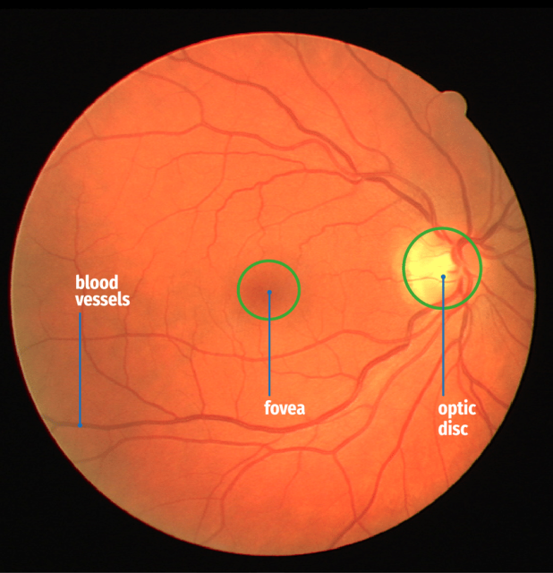 This photo of the retina shows that no blood vessels cross the fovea, leaving the centre of vision unobstructed.